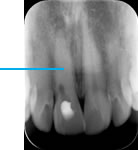 Calcified canal